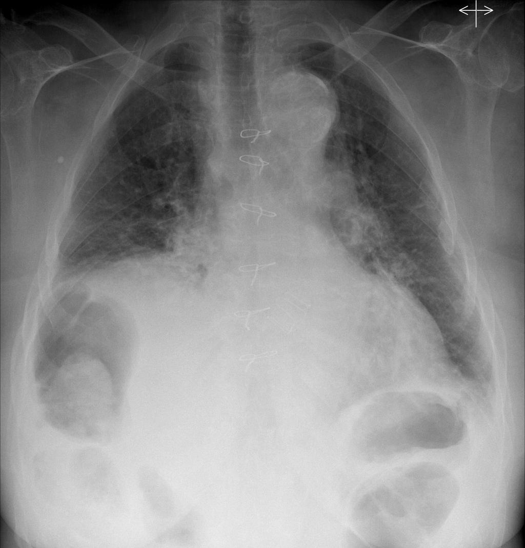 2. Causas de elevação diafragmática III- ALTERAÇÃO DO VOLUME PULMONAR Figura 8: Doente com DPOC.