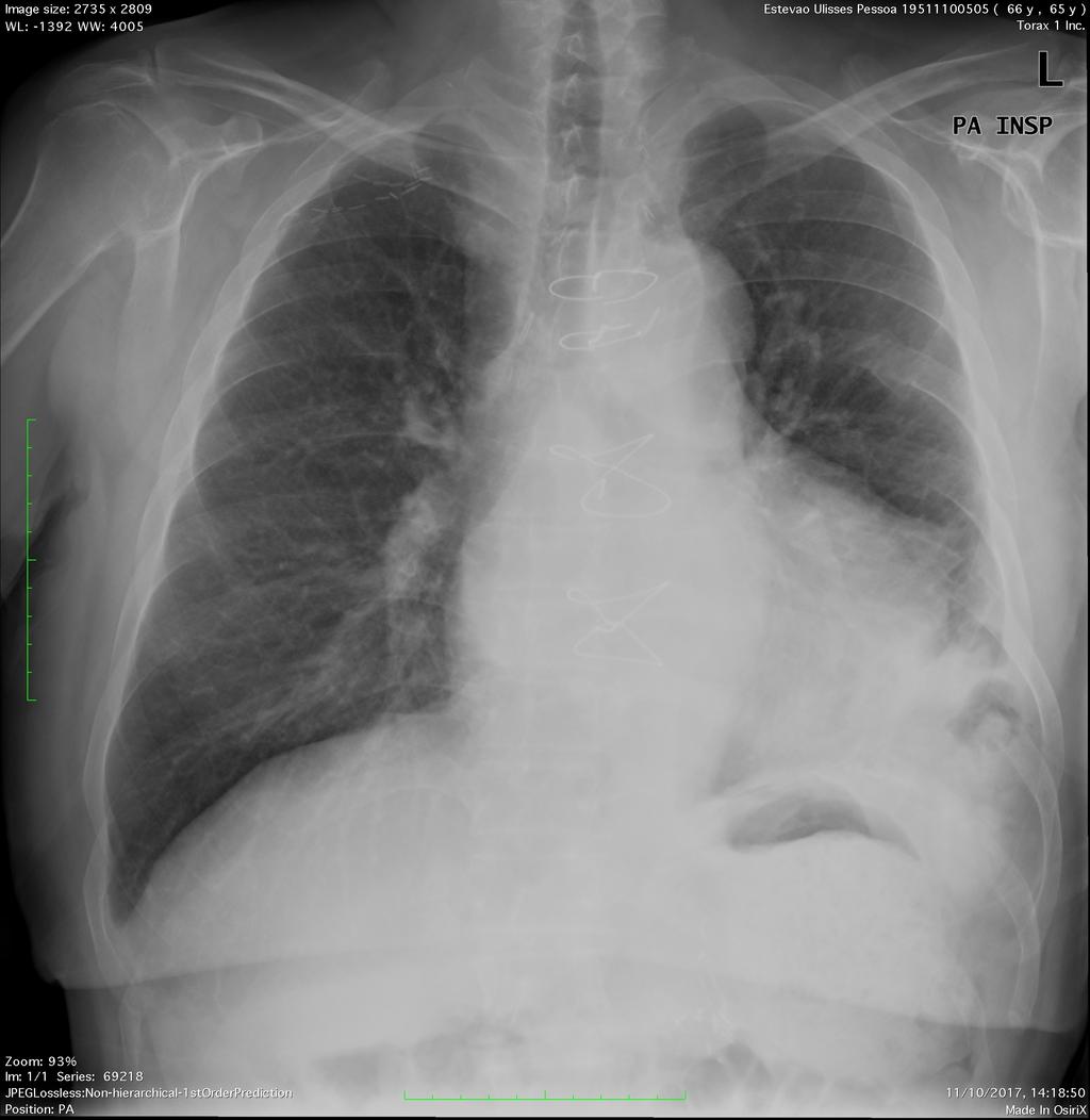 2. Causas de elevação diafragmática V- DOENÇA DIAFRAGMÁTICA Figura 12: Radiografia do toráx com imagem no hemitórax