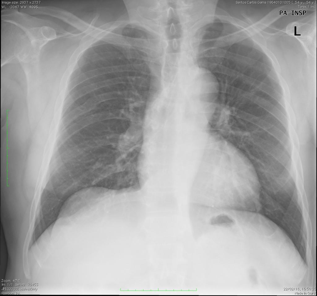 2. Causas de elevação diafragmática V- DOENÇA DIAFRAGMÁTICA Sinais radiológicos: - Bosseladura com contornos lisos. Restante traçado do hemidiafragma normal.