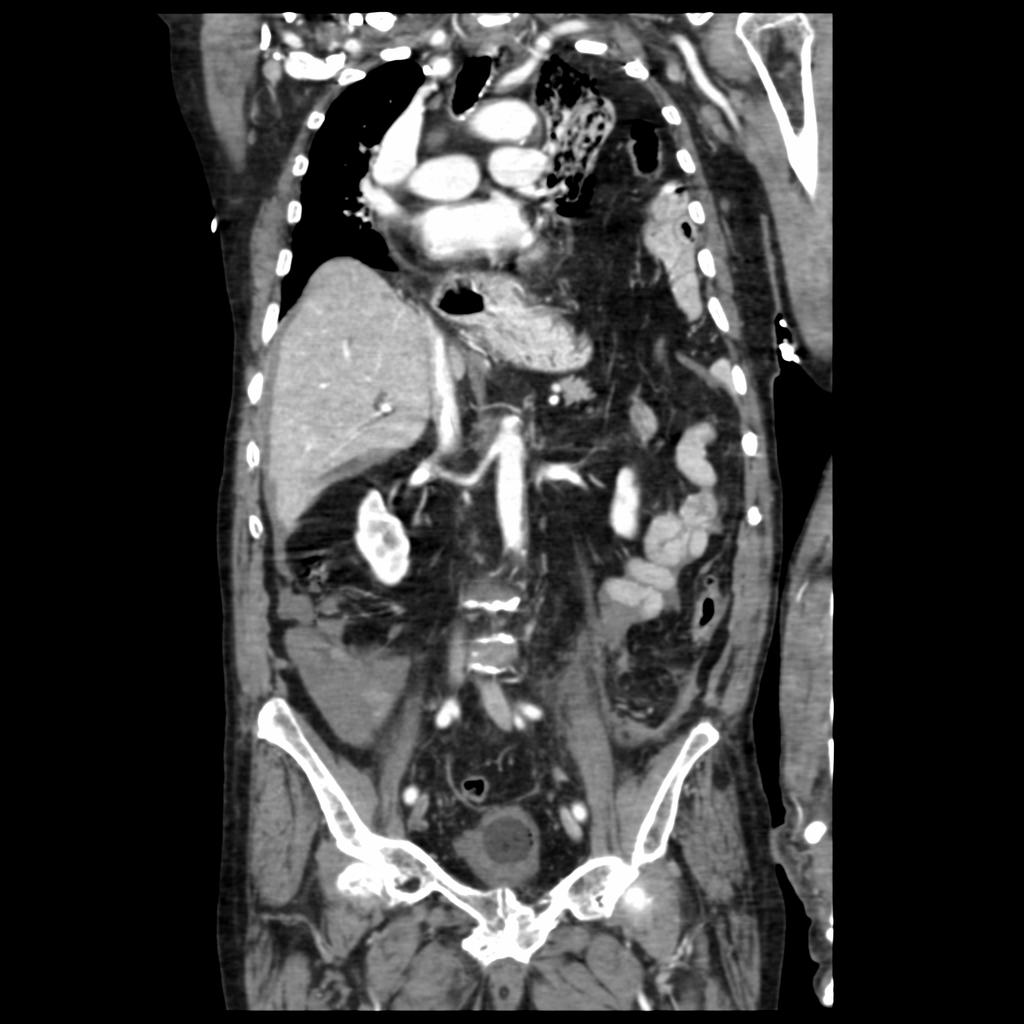 Radiografia do toráx com desvio do mediastino para a direita e imagem no hemitórax esquerdo que apresenta