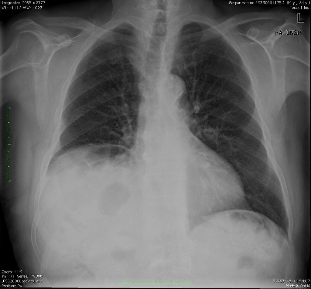 2. Causas de elevação diafragmática II- DOENÇA ABDOMINAL 1.