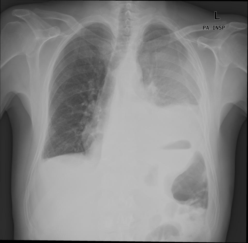 2. Causas de elevação diafragmática II- DOENÇA ABDOMINAL Figura 5: