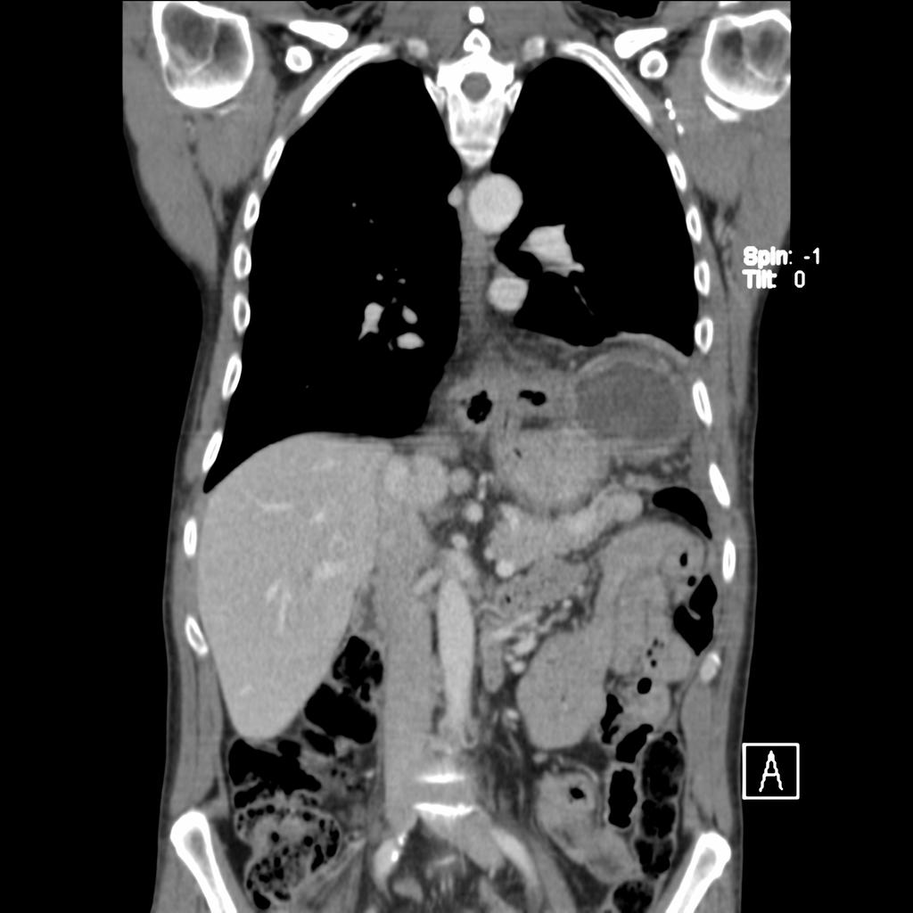 Em radiografia do tórax vemos hemicúpula direita elevada com derrame