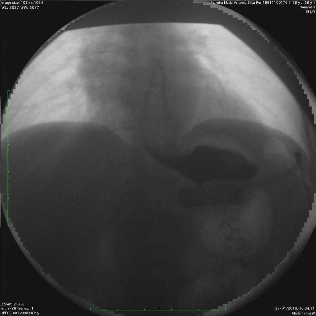 4.1 Cirurgias bariátricas - Banda gástrica ajustável BG Fig. 14: Imagem de exame de fluoroscopia de um doente com banda gástrica ajustável.