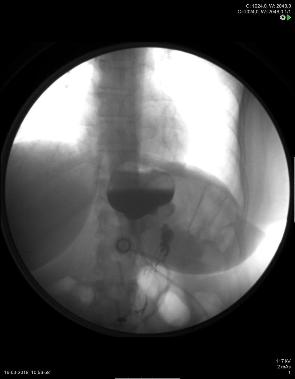 4.1 Cirurgias bariátricas - Banda gástrica ajustável BG Fig. 15: Imagem de exame de fluoroscopia de um doente com banda gástrica ajustável e queixas de vómitos e epigastralgias pós-prandiais.