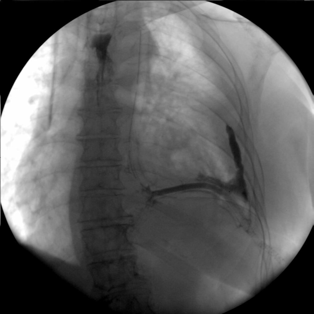 4.2 Cirurgias não bariátricas - Gastrectomia total Dt Da A B Fig.