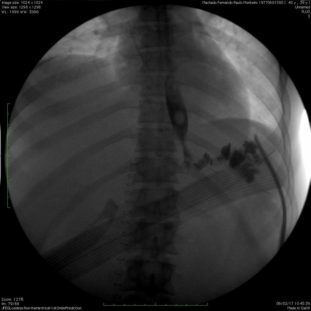 4.2 Cirurgias não bariátricas - Gastrectomia total Fig. 17: Imagem de exame de fluoroscopia de um doente submetido a gastrectomia total.