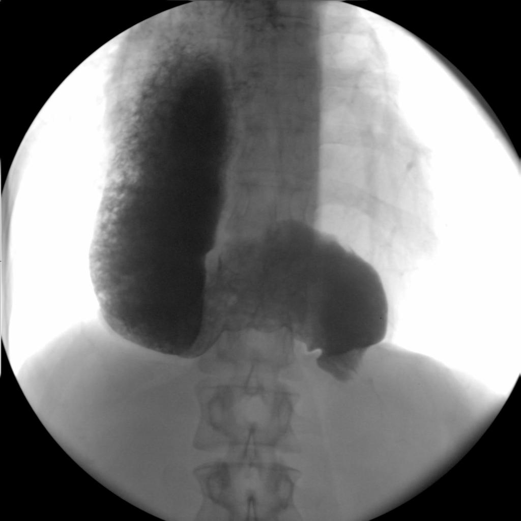 3. PROCEDIMENTOS ESOFÁGICOS Miotomia de Heller Fig. 1: Imagem de exame de fluoroscopia de um doente com acalásia, já submetido a miotomia, mas com recorrência dos sintomas.