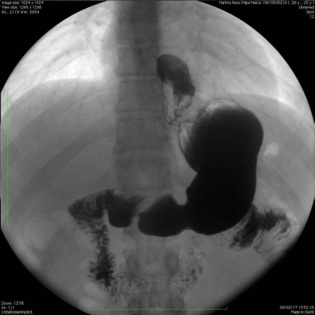 3. PROCEDIMENTOS ESOFÁGICOS Fundoplicaturas Fig.