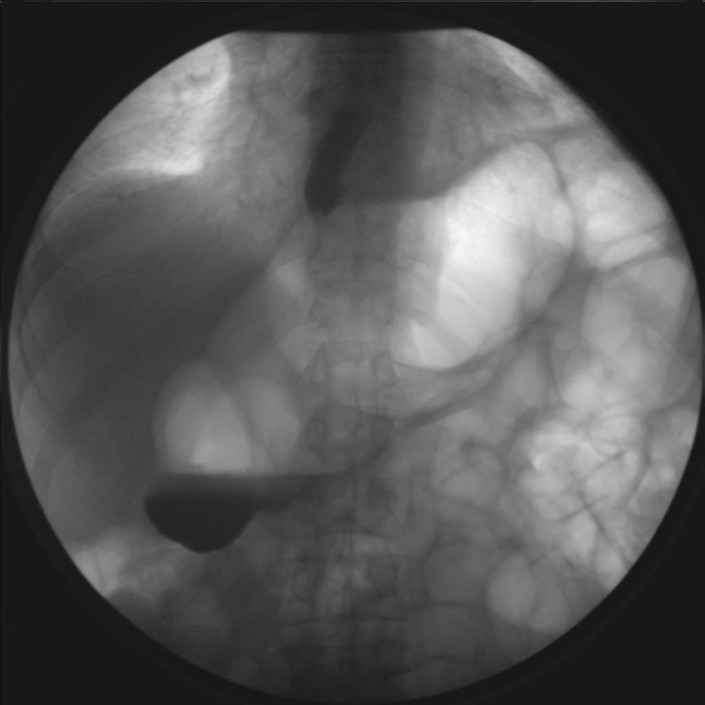 3. PROCEDIMENTOS ESOFÁGICOS Fundoplicaturas A B Fig.