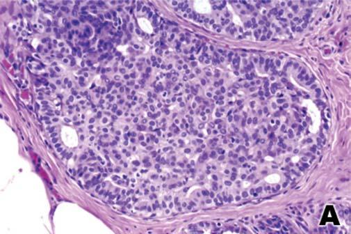 Salles MA, Sanches FSF, Perez AA, Gobbi H Figura 1 - (A) Hiperplasia ductal usual sem atipia (ou moderada/florida) diagnosticada originalmente como hiperplasia ductal atípica.