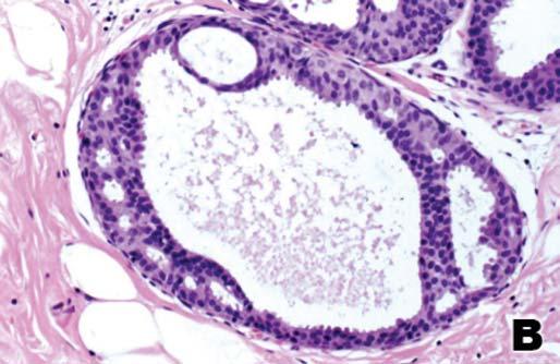 (C) Área de cancerização de lóbulo (setas) associada à carcinoma ductal in situ, com diagnóstico original de microinvasão. (D) Carcinoma tubular invasor (setas) não reconhecido no exame original.