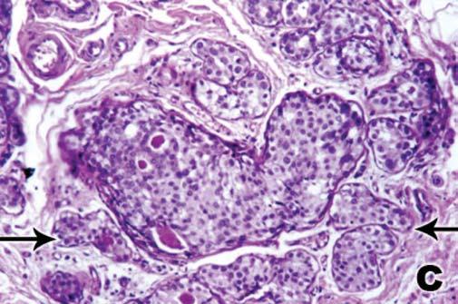 As LBNP envolvem cistos, ectasia ductal, metaplasia apócrina e as hiperplasias leves (caracterizada pela presença de três a quatro camadas de células acima da membrana basal).