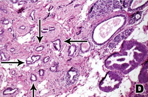 envolvidos e cruzar estes espaços formando pontes ou preenchendo parcial ou totalmente estes espaços ). A HA envolve menos que dois espaços ou ductos, ou mede em conjunto menos de 2 a 3 mm.