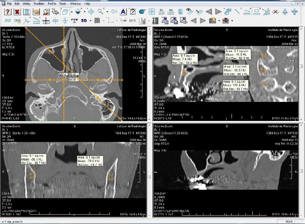 Figura 4.2 - Janela do software e-film. No corte axial existem 2 linhas de orientação que mostram os cortes sagital e coronal.