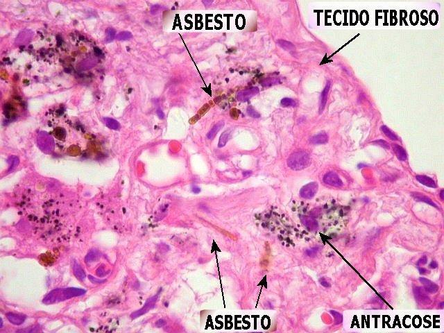 Doenças Causadas pelo Asbesto ou Amianto Asbestose que é o