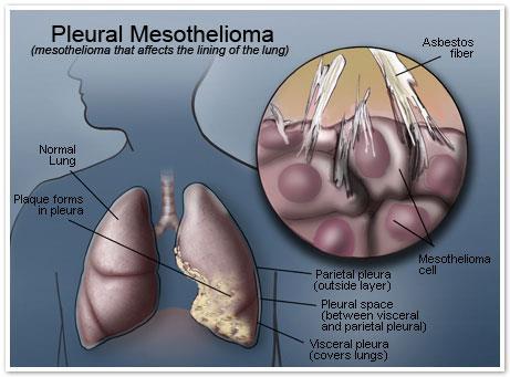 Mesotelioma de pleura (tecido que reveste pulmão) e peritônio(tecido que reveste a cavidade abdominal) - tumor maligno que mata