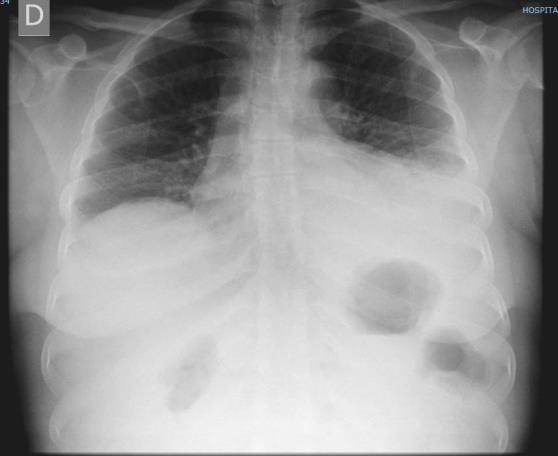 Jan/2016 Alta HSFX Fev/2016 Consulta CDP Mar/2016 SU HFF Toracocentese Radiografia de Tórax PA Citologia NEGATIVA para células malignas - Líquido turvo - ADA 175,35UI/L - 2891 cel/ul, com predomínio