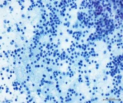 directo micobactérias (coloração Ziehl- Neelsen) BAAR NEGATIVO PCR DNA