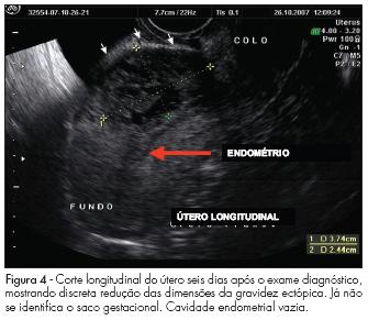 Diagnóstico: Valores Séricos de β-hcg acima da Zona Discriminatória +