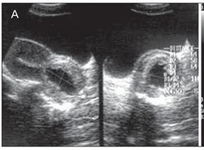 ampulheta Canal cervical dilatado Saco gestacional na endocérvice Tecido placentário no canal cervical