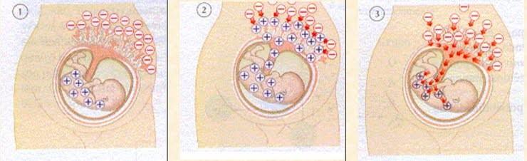 Eritroblastose Fetal Doença hemolítica do recém