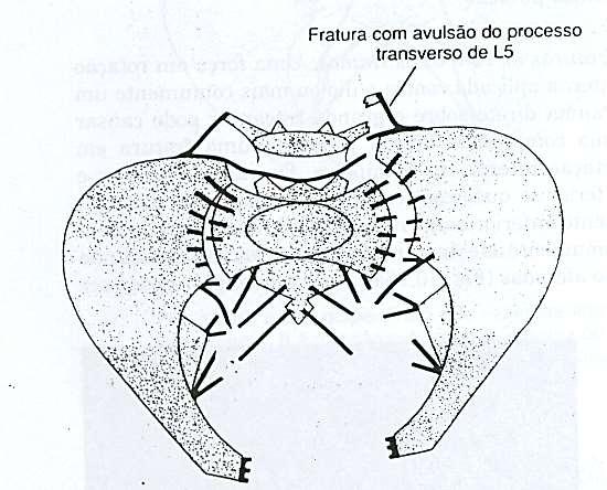 Lesão de Sínfise +