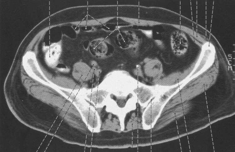 Avaliação Radiológica Tomografia Computadorizada