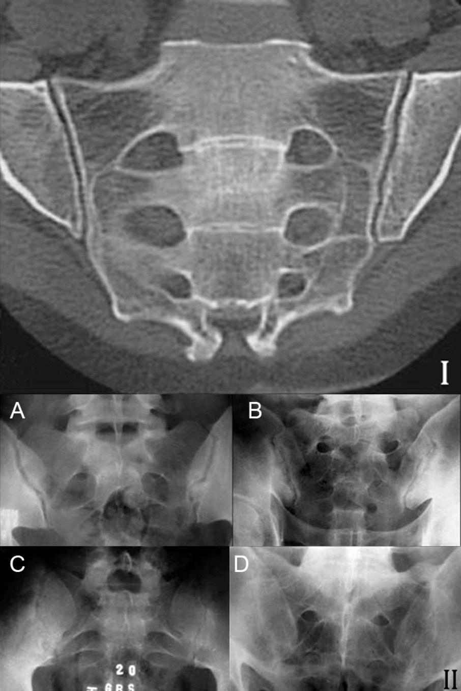 Grau 0 normal; (A) grau I suspeito; (B) grau II discreta irregularidade e esclerose das superfícies articulares, com o espaço articular preservado; (C) grau III redução articular, além de