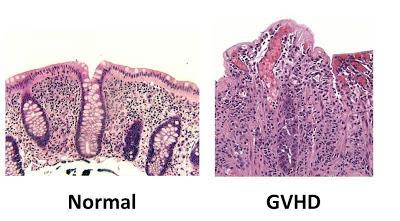 Complicações do TCTH DECH aguda intestinal Esquerda: Histologia da mucosa normal do cólon.