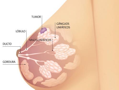 Câncer de Mama O câncer de mama é um câncer que começa no tecido mamário; É um tumor maligno que se desenvolve nos seios, caracterizado por um crescimento rápido e desordenado de células; Um caroço