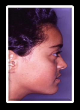 16 CASO CLÍNICO Paciente do sexo feminino, com 14 anos, cuja análise facial mostra um perfil reto, com o terço inferior