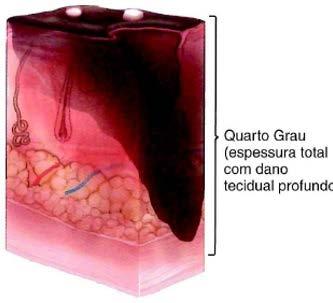 Profundidade da queimadura 4º grau: acometem não sometem todas as camadas da