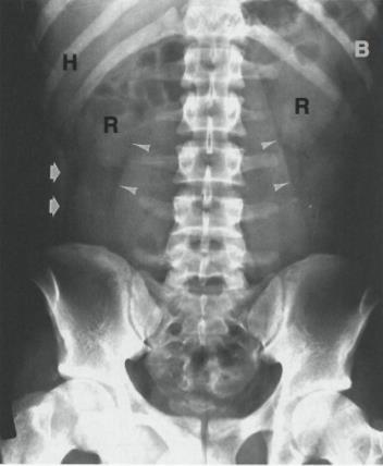 Ângulo hepático do colón (H) e a parte inferior do baço (B) são representados por uma sombra adiposa.