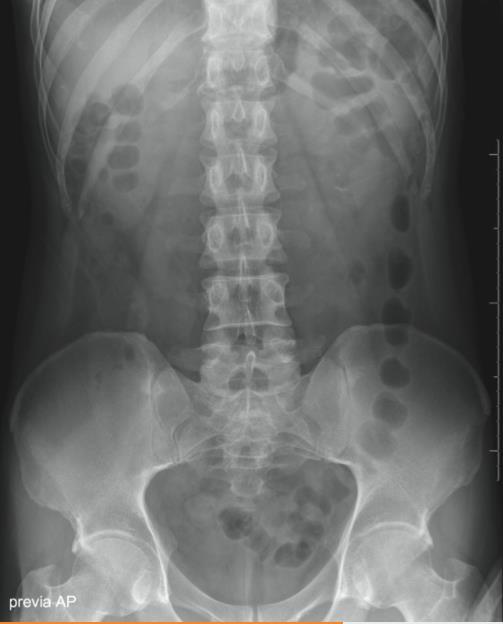 Radiografia simples de abdome em incidência