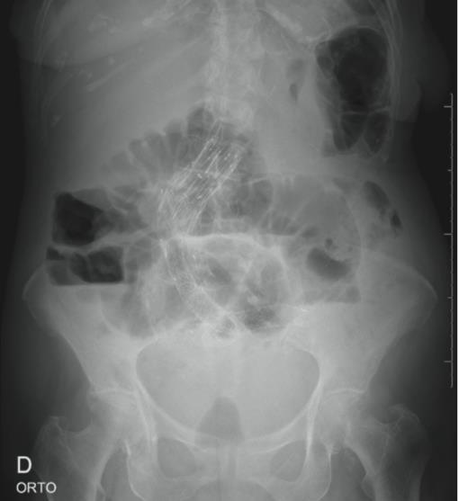 Radiografia simples de abdome em ortostase, indicando