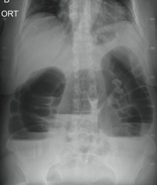 Radiografia simples de abdome em ortostase, indicando distensa o de co lon.