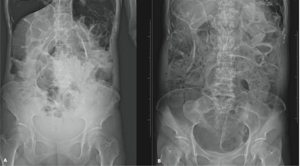 Radiografias simples de abdome realizadas em ortostase e decúbito dorsal,