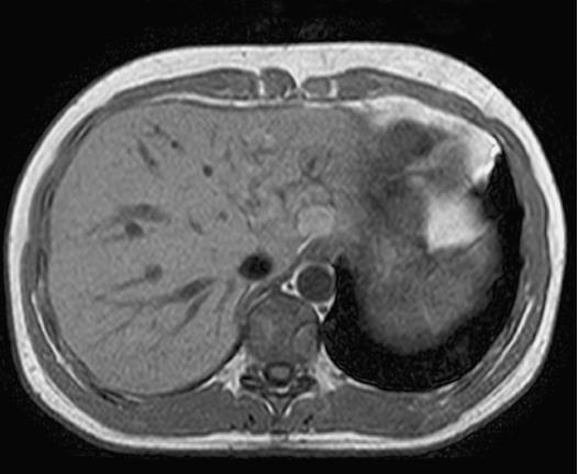 RM em corte axial com