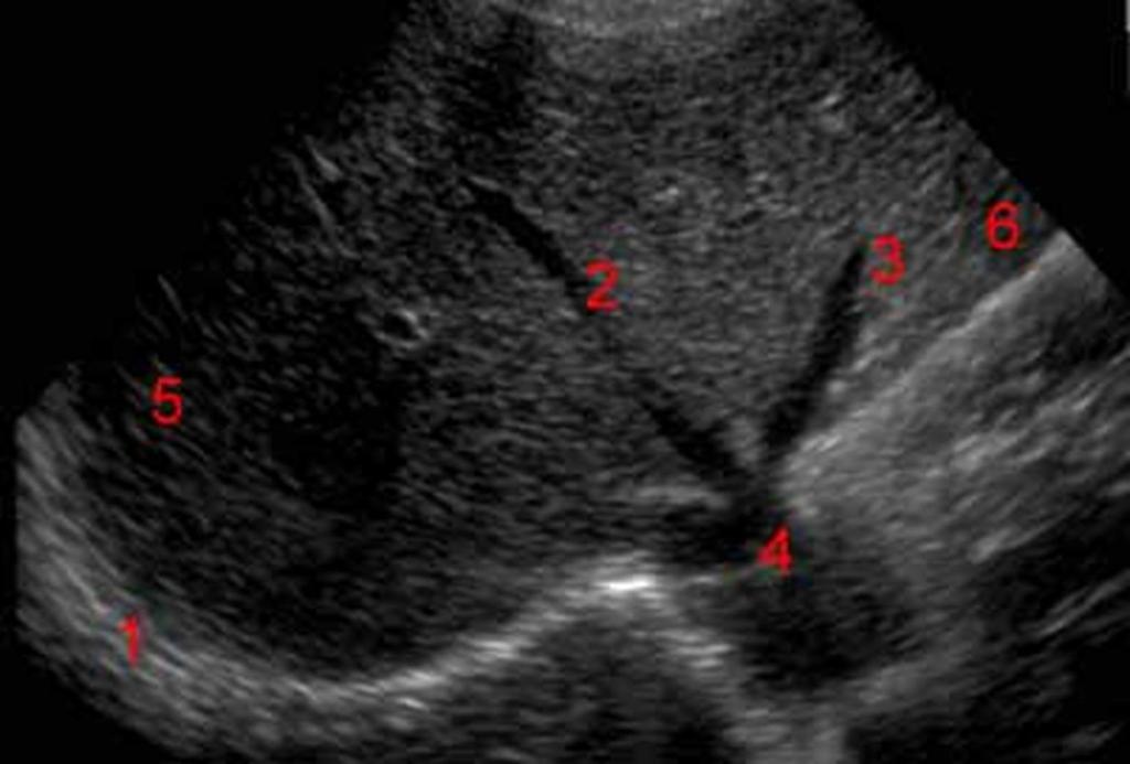 1- Diafragma 2-Veia hepática média 3-Veia hepática esquerda