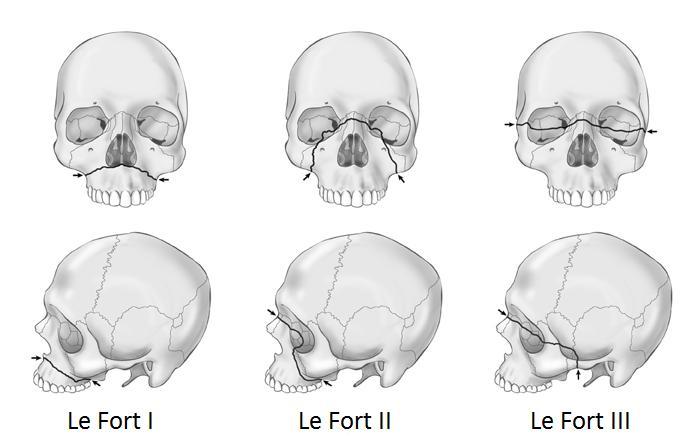 31 essencialmente separam a face ao longo da base do crânio. A linha de fratura se estende da sutura nasofrontal ao longo da parede medial da órbita pela fissura orbital superior.