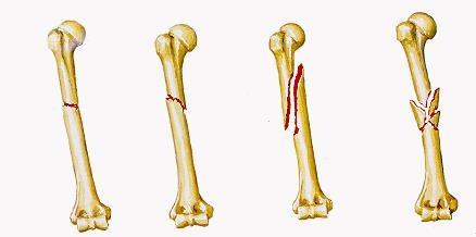 Tipos de Fraturas do Úmero