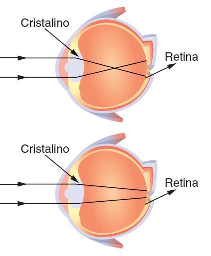 Exercício 2 Resolução SILVIA Imagem se forma ANTES da retina. Olho muito convergente. Correção: lente divergente.