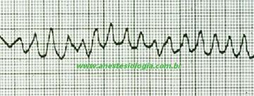 RITMOS DE PARADA CARDÍACA FIBRILAÇÃO VENTRICULAR Na FV não há