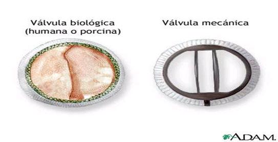 Ausculta Estalidos Ruídos secos, de curta duração, diastólicos Mitral Estalido