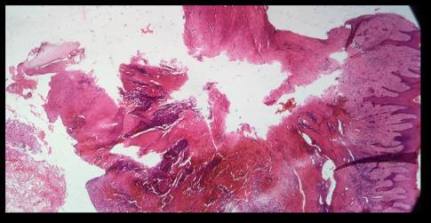 Figura 7: Aparência clínica após dois anos de pós-operatório. Os cortes histológicos revelam fragmentos de mucosa revestidos por epitélio estratificado pavimentoso ceratinizado.