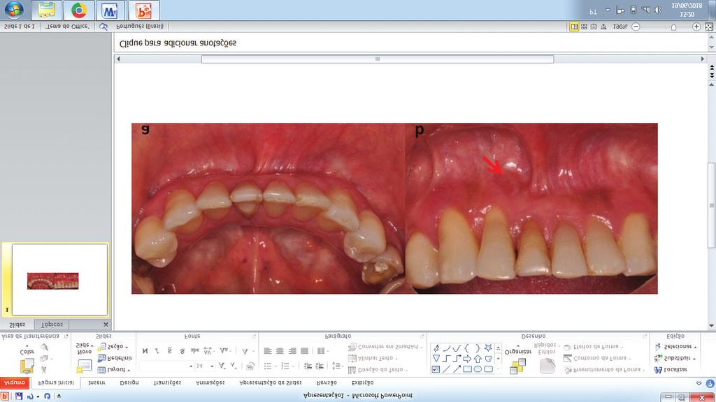 Figura 7: (a) Vista oclusão mostrando alimento dental e ausência de tumefação. (b) Vista vestibular mostrando presença do incisivo central e cicatriz na linha mucogengival (seta).