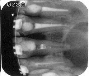 unilocular, estendia-se do 11 ao 22 (Figura 2), tendo os dentes 11 e 22