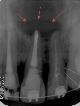 Orientou-se o paciente a realizar a restauração definitiva deste dente o mais breve possível; e também da necessidade de acompanhamento semestral para proservação do caso.