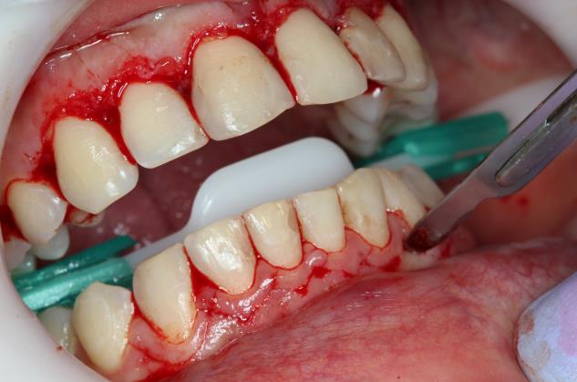 Figura 5. Incisão com bisturi. A incisão secundária, realizada com o gengivótomo de Orban, teve como objetivo a remoção do tecido gengival das áreas interproximais.